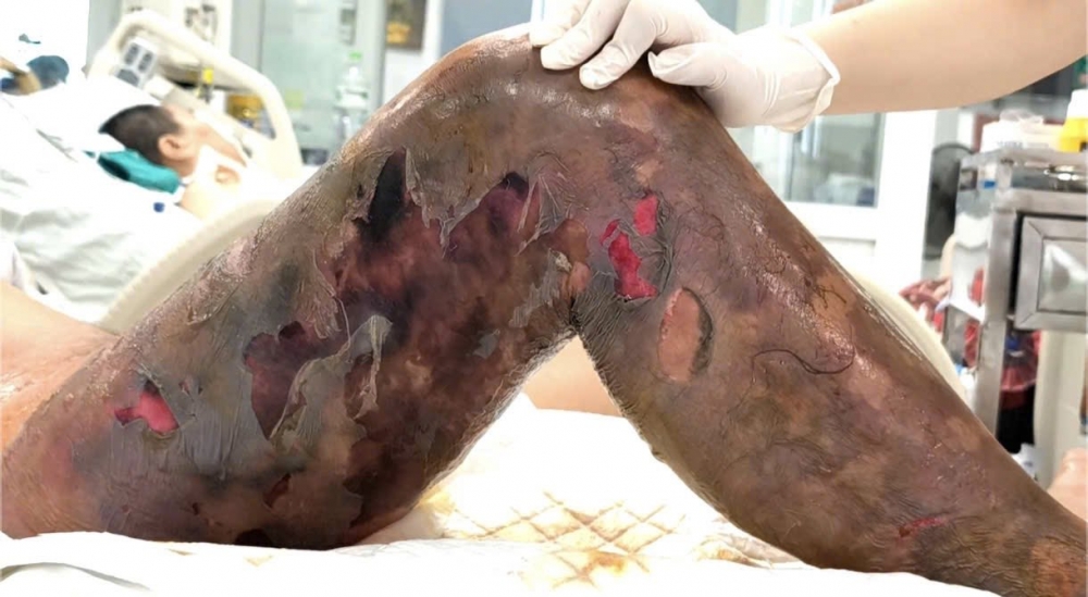 Vùng đùi bệnh nhân bị hoại tử khi được đưa vào bệnh viện