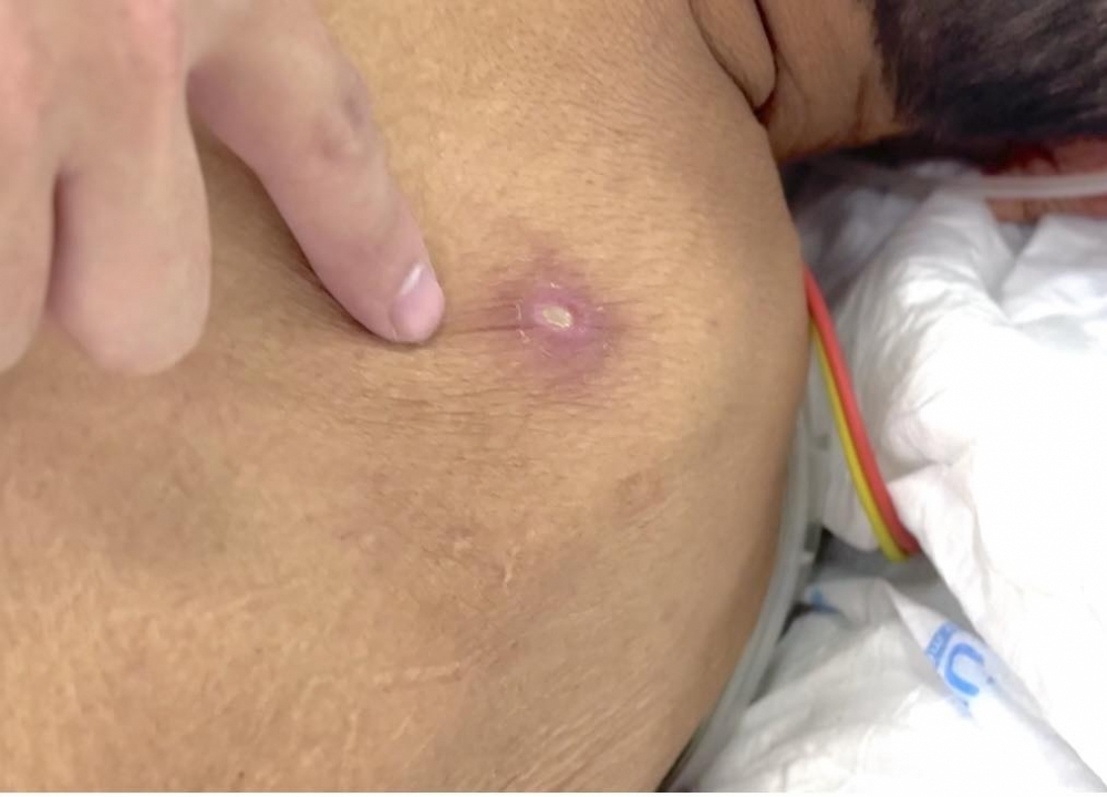 sốt mò là bệnh truyền nhiễm cấp tính, lây qua vết đốt của ấu trùng mò 