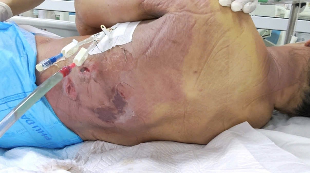 vùng cổ - lưng – hông trái sưng nề đỏ, bong da, lan sang cả mạn sườn phải