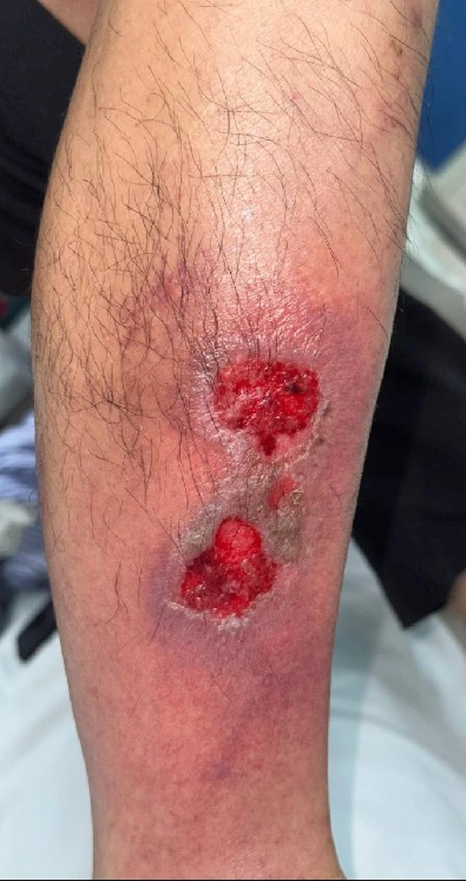 Ngộ độc nặng do uống thuốc nhầm liều Ngộ độc nặng do uống thuốc nhầm liều