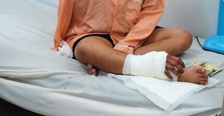 Các bác sĩ đã ghép tạm thời bàn tay vào cẳng chân phải của bệnh nhân Các bác sĩ đã ghép tạm thời bàn tay vào cẳng chân phải của bệnh nhân