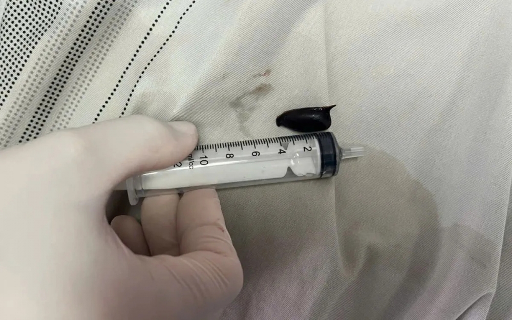 Hạt hồng xiêm được gắp từ phổi bệnh nhân