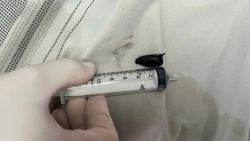 hat hong xiem trong phoi khien nguoi dan ong ho suot 2 nam