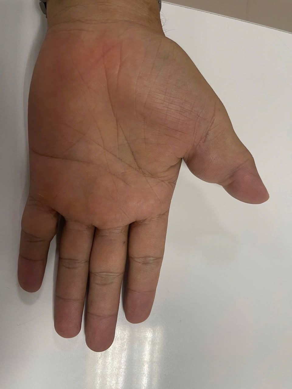 mắc dị dạng thông động – tĩnh mạch (AVM) – một bệnh lý mạch máu hiếm gặp, nhất là ở bàn tay