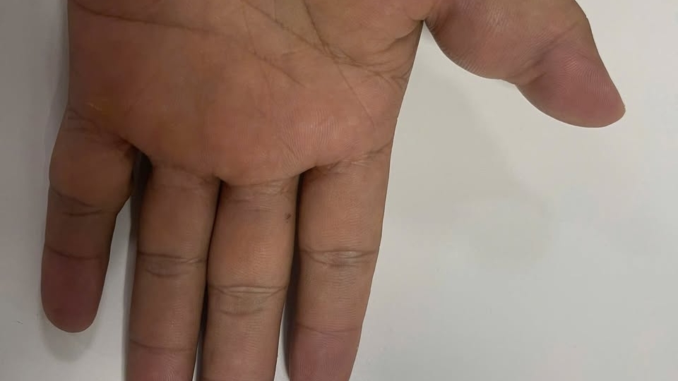 Khối u 17 năm ăn mòn xương ngón tay bệnh nhân