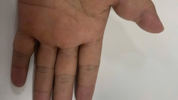 Khối u 17 năm ăn mòn xương ngón tay bệnh nhân