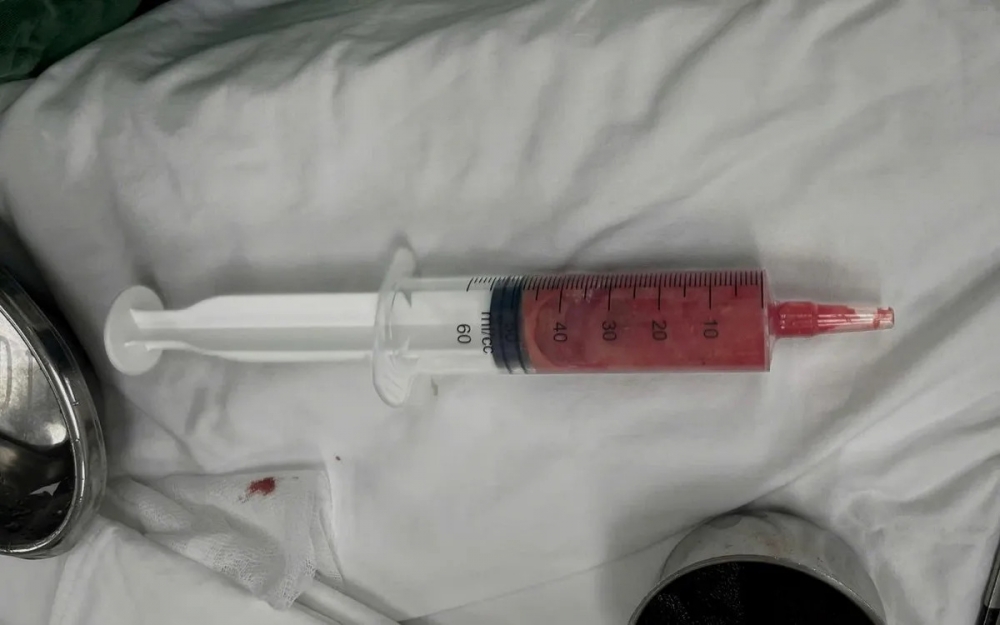 Dịch mủ được hút ra từ mô vú trong ca phẫu thuật (Ảnh: BVCC)