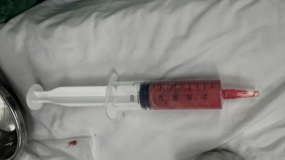 Biến chứng nặng sau khi tiêm chất làm đầy không rõ nguồn gốc