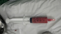 Biến chứng nặng sau khi tiêm chất làm đầy không rõ nguồn gốc