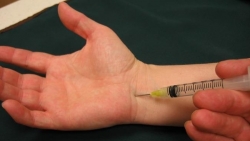 Hoại tử nặng sau khi tiêm kháng viêm điều trị hội chứng ống cổ tay