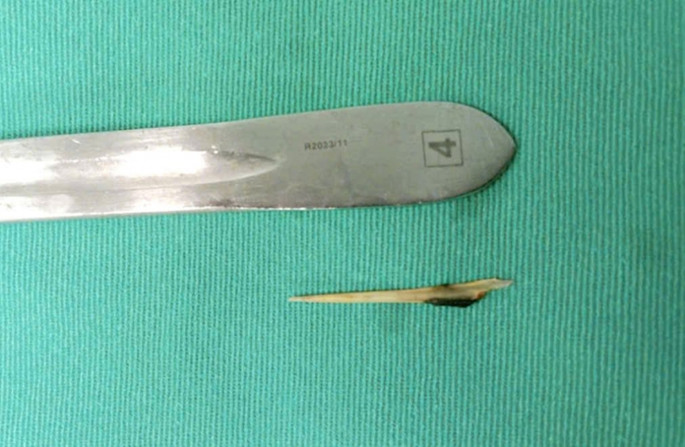 Xương cá được lấy ra khỏi bụng bệnh nhân