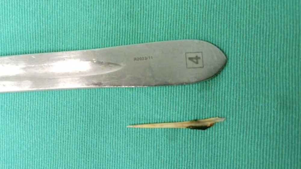 Hy hữu bệnh nhân bị xương cá dài 4cm đâm thủng ruột non gây viêm ổ bụng nặng