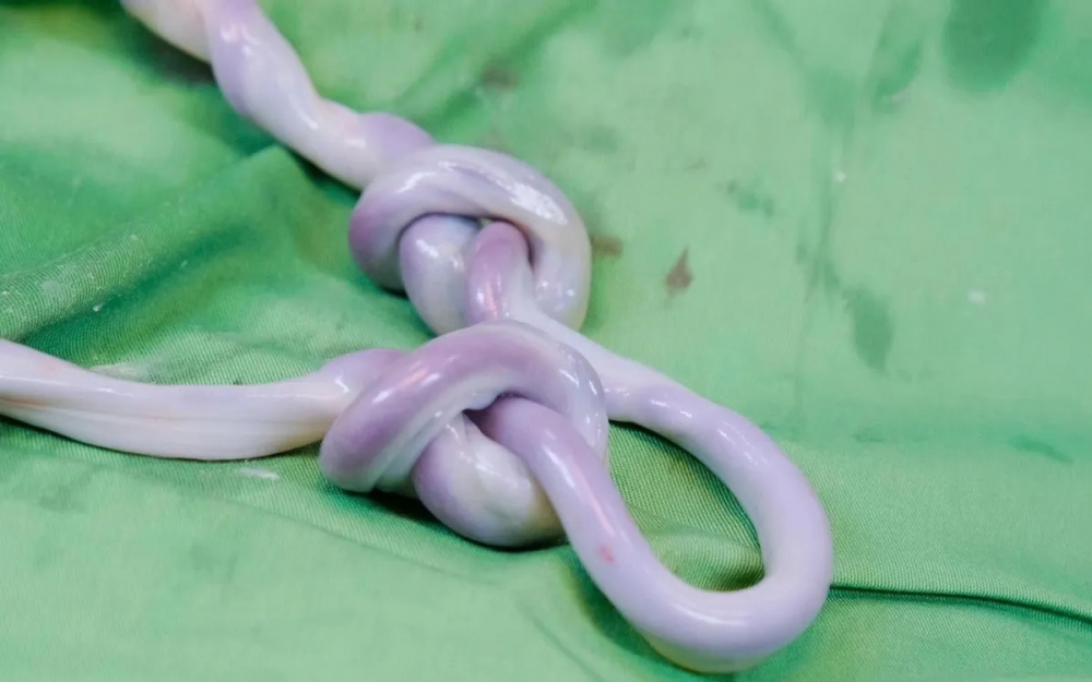 dây rốn bị thắt hai nút, biến chứng hiếm gặp có thể gây suy thai cấp nếu không xử trí kịp