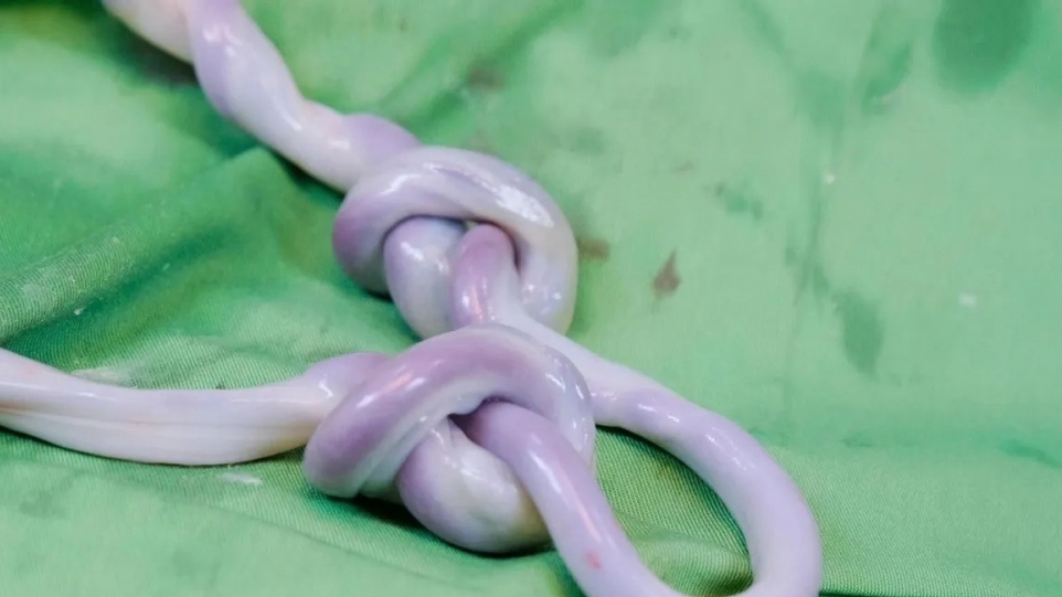 Bé trai chào đời với dây rốn thắt hai nút