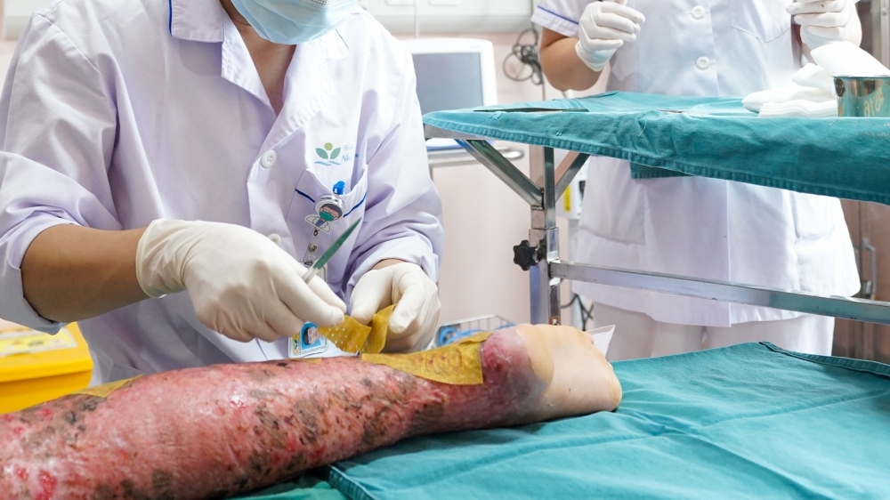 Bé trai 12 tuổi bị bỏng nặng do tự làm thí nghiệm với cồn tại nhà