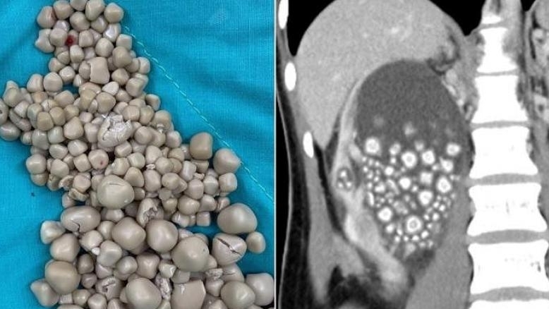 Bác sĩ gắp 300 viên sỏi trong thận cô gái trẻ