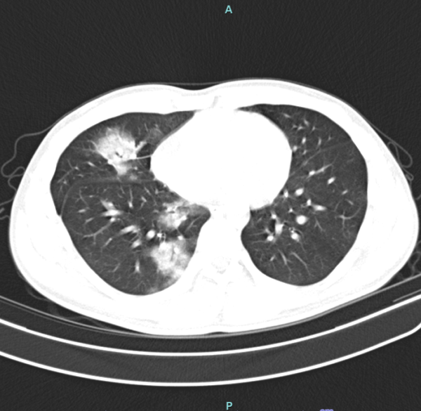 Kết quả chụp cắt lớp vi tính ngực cho thấy tổn thương thâm nhiễm rộng thùy dưới phổi phải (Ảnh: BV)