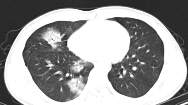 Nam thanh niên có phổi như ông già vì hút thuốc lá điện tử