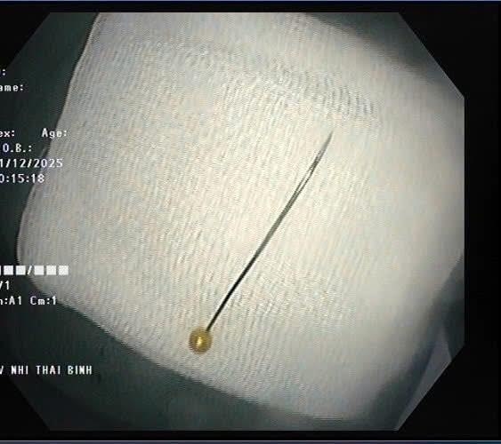Các bác sĩ Bệnh viện Nhi Thái Bình đã gắp thành công cây kim may khỏi tá tràng bệnh nhi