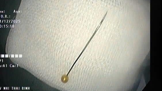 Cây kim dài 4 cm trong tá tràng bé 11 tháng tuổi