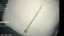 Cây kim dài 4 cm trong tá tràng bé 11 tháng tuổi