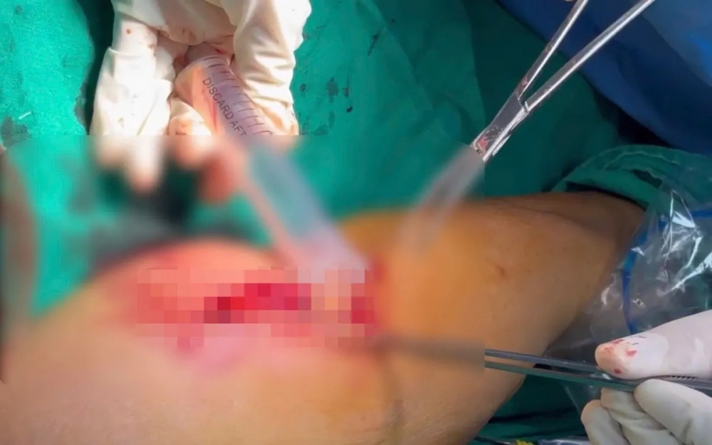 Nhiều người dân tìm đến các điểm tiêm truyền tự phát, không bảo đảm vô khuẩn, dẫn đến nguy cơ biến chứng nặng như áp xe, nhiễm trùng lan rộng