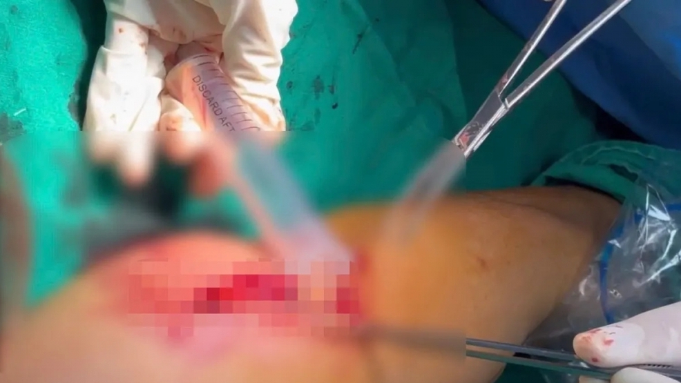 Phú Thọ: Nhiều trường hợp biến chứng nặng do tiêm truyền tại cơ sở không đảm bảo