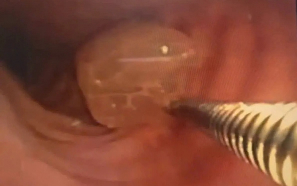 Bệnh viện Đa khoa TP Cần Thơ vừa cứu sống bệnh nhân nghẹt thở nguy kịch do hóc nửa quả nho xanh