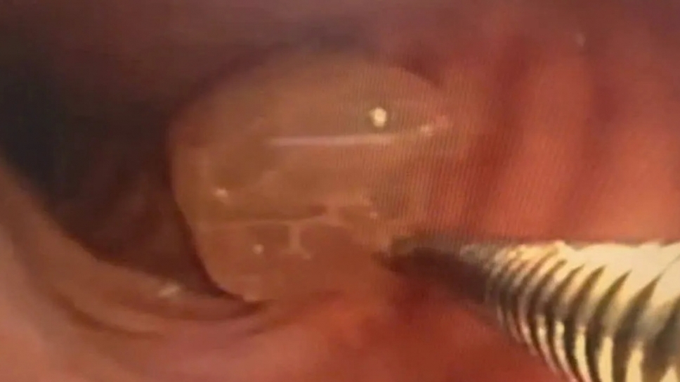 Cấp cứu bệnh nhân hóc nửa quả nho ở phế quản