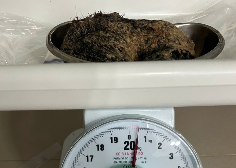 Các bác sỹ Khoa Ngoại đã phối hợp với Khoa Phẫu thuật Gây mê Hồi sức hoàn thành ca phẫu thuật lấy một búi tóc nặng 500gram ra khỏi dạ dày một bệnh nhi 6 tuổi