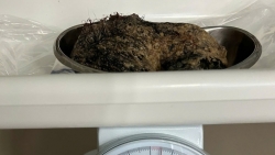 phau thuat lay bui toc nang nua kg trong bung benh nhi