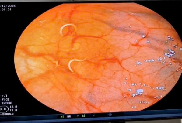 nhiều con giun màu trắng ngà, dài khoảng 0,3–0,5 cm, trong lòng đại tràng nhiều con giun màu trắng ngà, dài khoảng 0,3–0,5 cm, trong lòng đại tràng