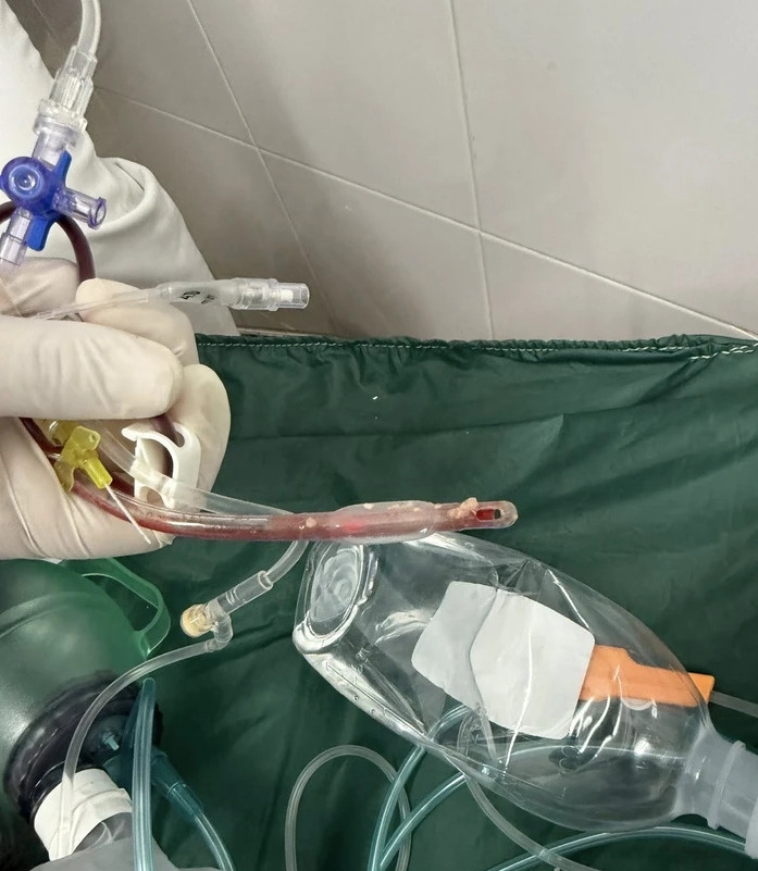 Thức ăn nghẹt dính vào ống nội khí quản sau khi hồi sinh tim phổi thất bại (Ảnh: BVCC)