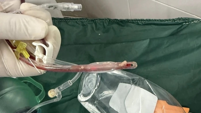 Bé gái 3 tuổi tử vong do sặc thức ăn tại nhà trẻ