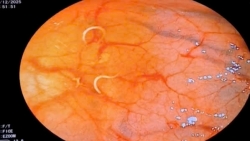 phat hien nhieu giun toc trong dai trang benh nhan co thoi quen an rau song