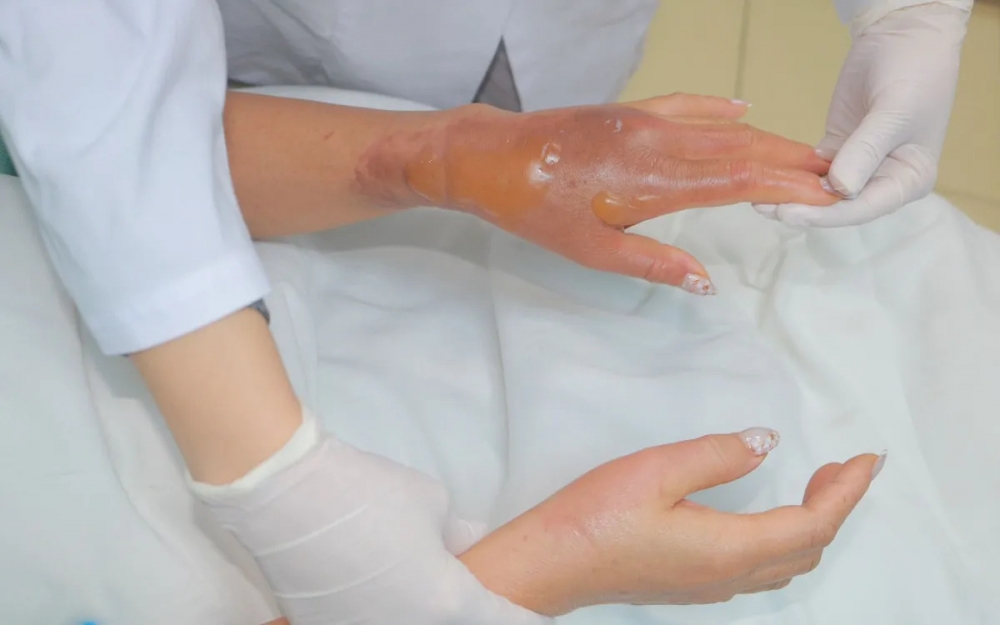 Bàn tay bệnh nhân bị bỏng nặng do hoá chất thông bồn cầu phát nổ chất thông bồn cầu 