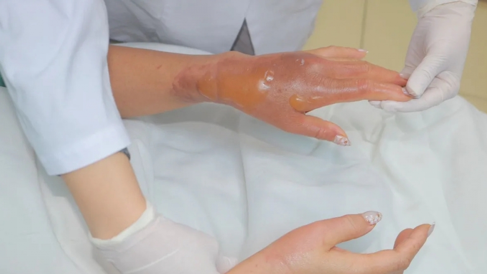 Hoá chất thông bồn cầu phát nổ gây bỏng nặng vùng mặt và tay
