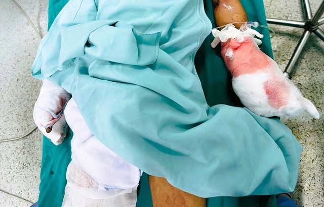 Thanh Hoá: Học sinh lớp 6 bị nát bàn tay do pháo nổ