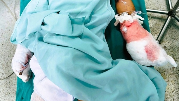 Thanh Hoá: Học sinh lớp 6 bị nát bàn tay do pháo nổ