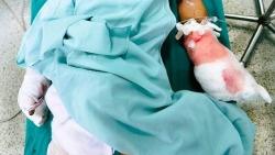 Thanh Hoá: Học sinh lớp 6 bị nát bàn tay do pháo nổ