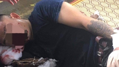 Nghệ An: Nổ pháo tự chế, nam thanh niên nguy kịch