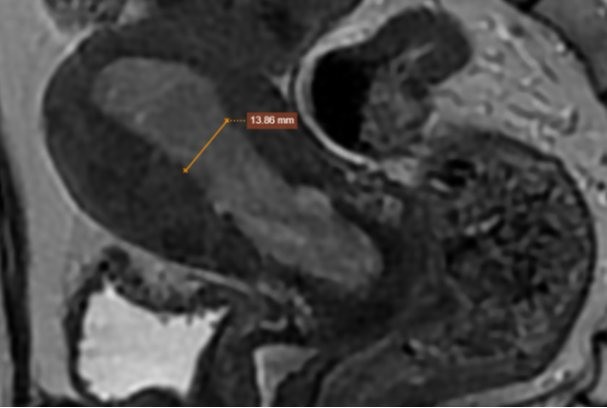 hình ảnh chup MRI ghi nhận niêm mạc tử cung dày 13 - 15mm