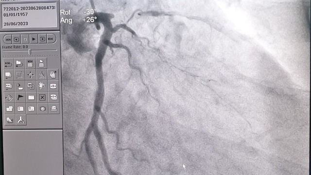 Người đàn ông hút thuốc lá lâu năm, tình cờ phát hiện bị hẹp động mạch vành