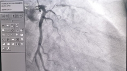 Người đàn ông hút thuốc lá lâu năm, tình cờ phát hiện bị hẹp động mạch vành