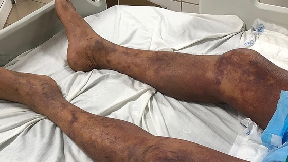 Thêm trường hợp suy đa tạng, thở máy vì ăn thịt lợn bệnh