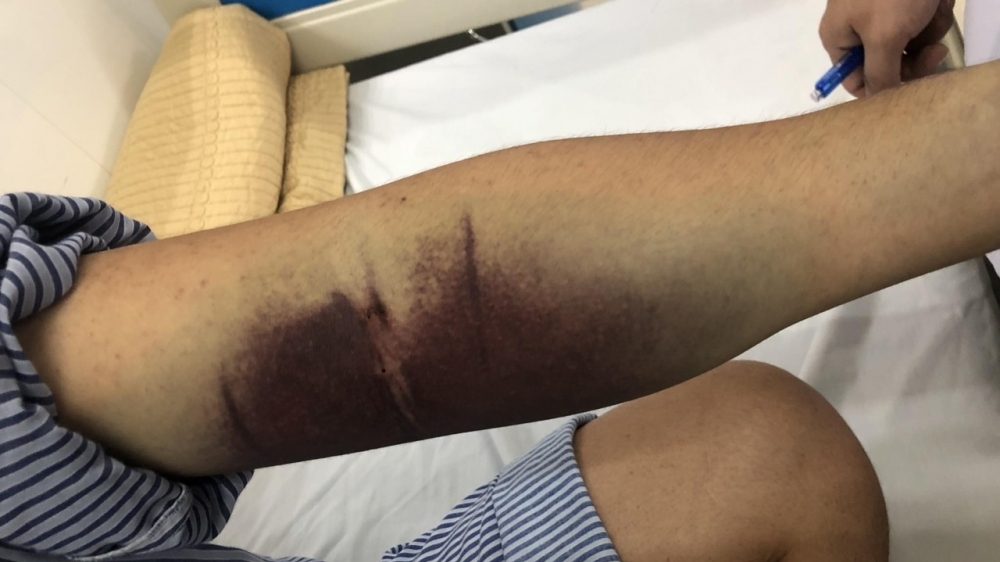 Nguy cơ biến chứng với người bệnh đái tháo đường bị sốt xuất huyết