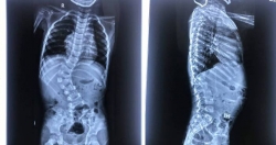 sua cong veo cot song cho benh nhi 3 tuoi