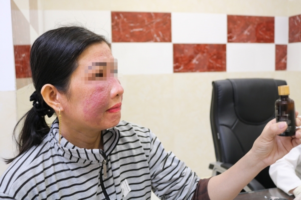 Mặt sưng nề vì bôi trắng da cấp tốc