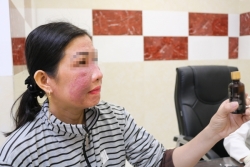 Mặt sưng nề vì bôi trắng da cấp tốc