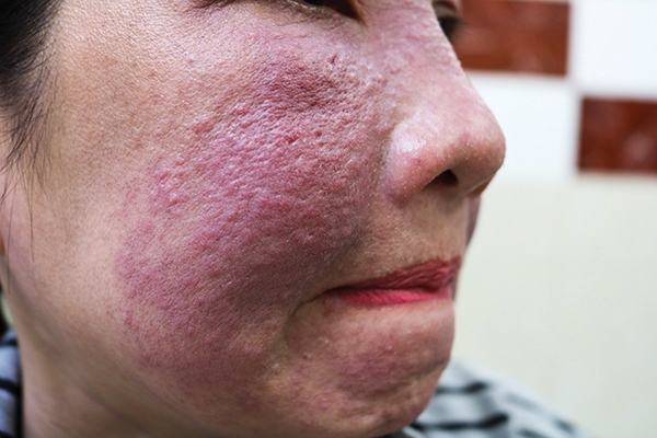 Hiểm họa từ “mỹ phẩm thảo  dược thiên nhiên”